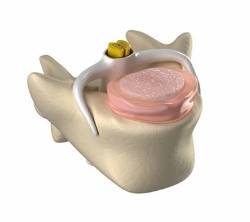 Cirugías con prótesis