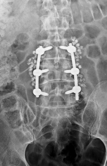 Cirugías de mínima invasión en neurocirugía