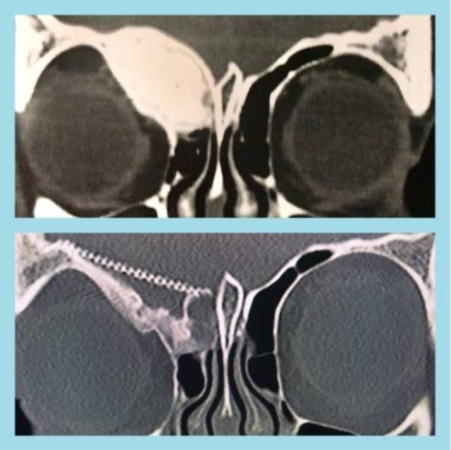 Displasia fibrosa Blogs Quirónsalud
