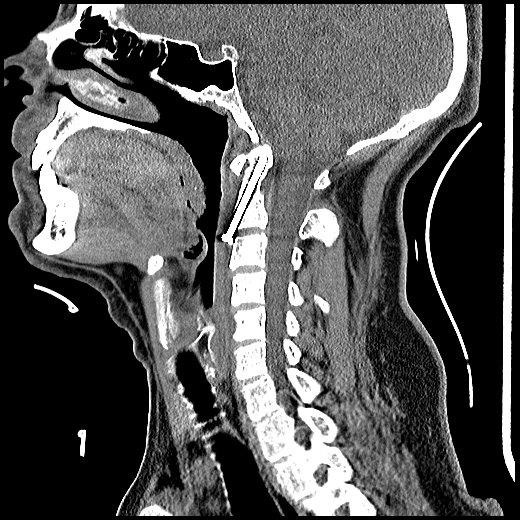 Fractura de odontoides