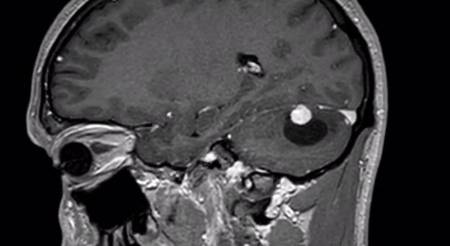 Hemangioblastoma cerebeloso