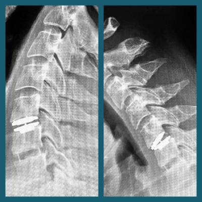 hernias vesicales