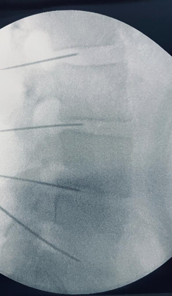 Tratamiento biológico de la discopatía degenerativa lumbar_2