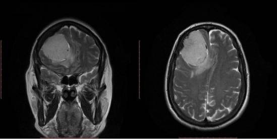 Tumor cerebral, antes