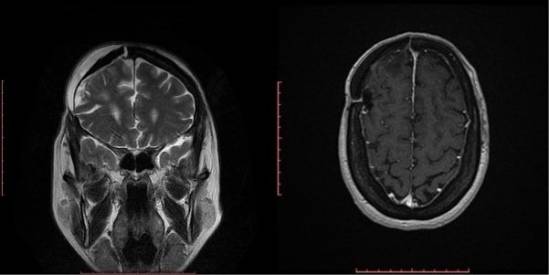 Tumor cerebral, después