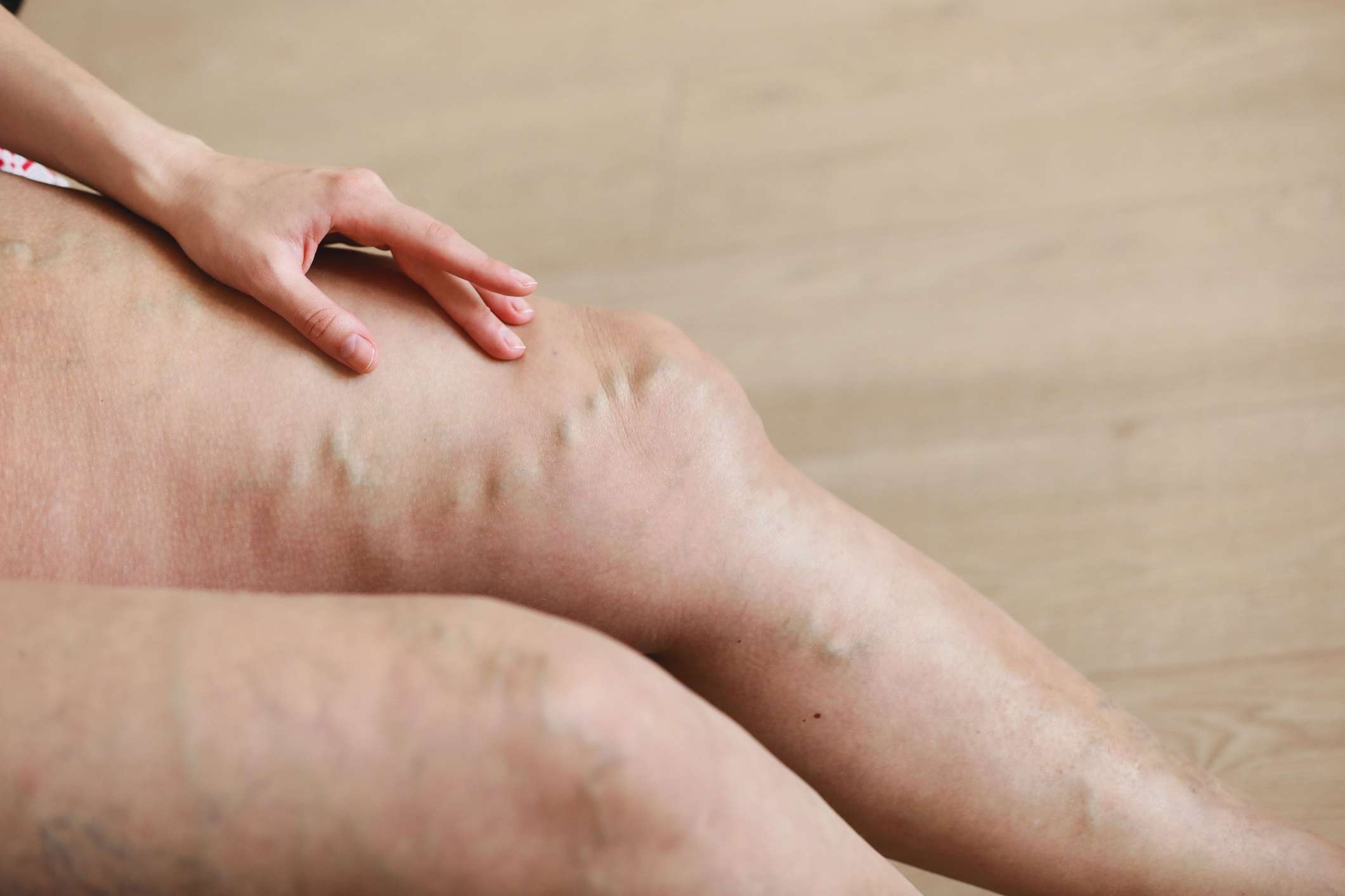 Varices tronculares (1) (1)