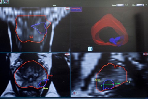 BIOPSIA DE PROSTATA POR FUSION 2 campodegibraltar