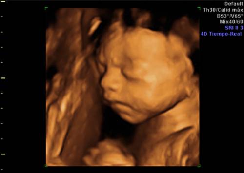 ecografia_4D_quironsalud_campodegibraltar