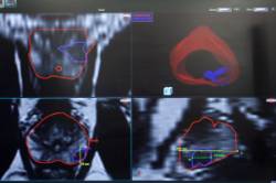 BIOPSIA DE PROSTATA POR FUSION 2 campodegibraltar