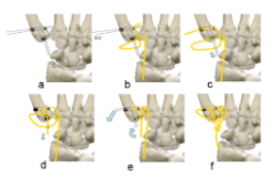 INFOGRAFÍA RIZARTROSIS PULGAR