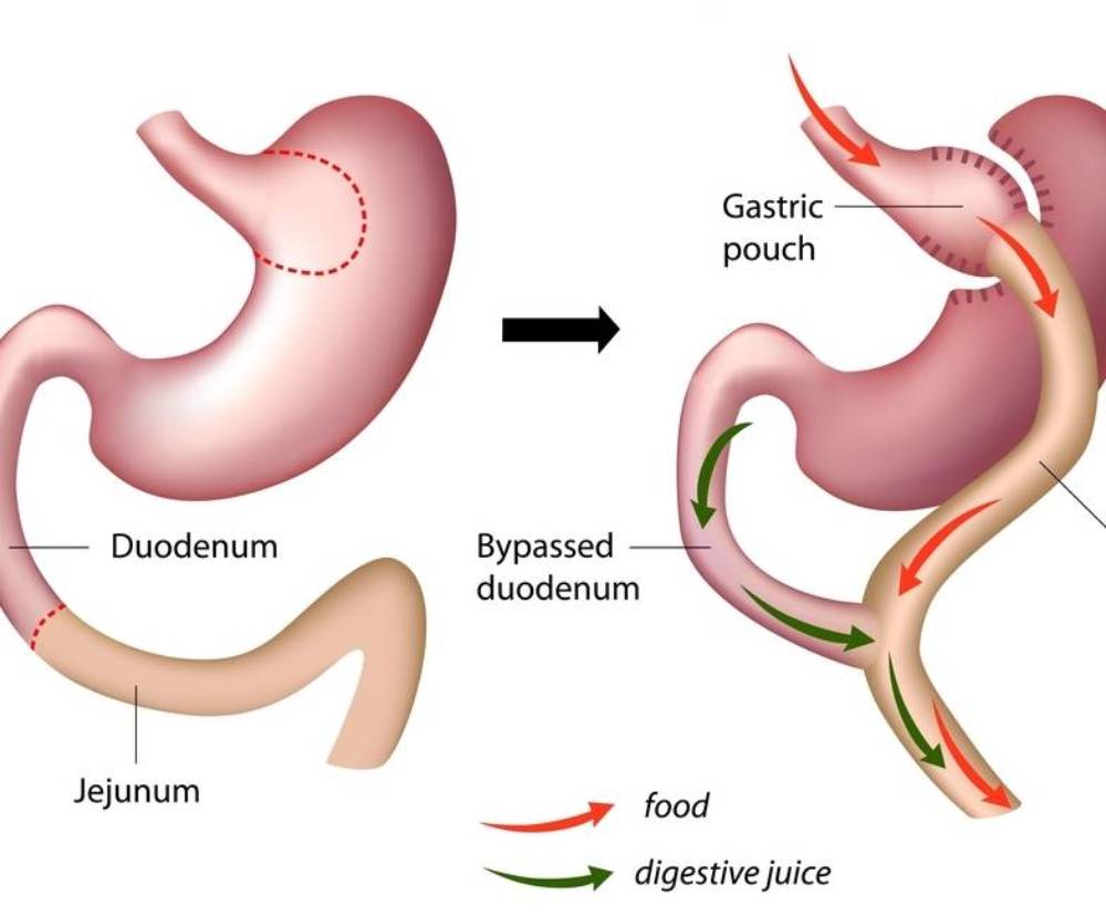 cirugia-bariatrica-diabetes