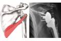 Prótesis invertida de hombro con transferencia de dorsal derecho
