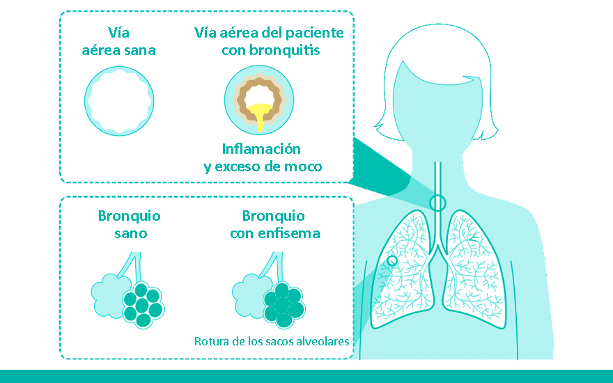 grafico_epoc1