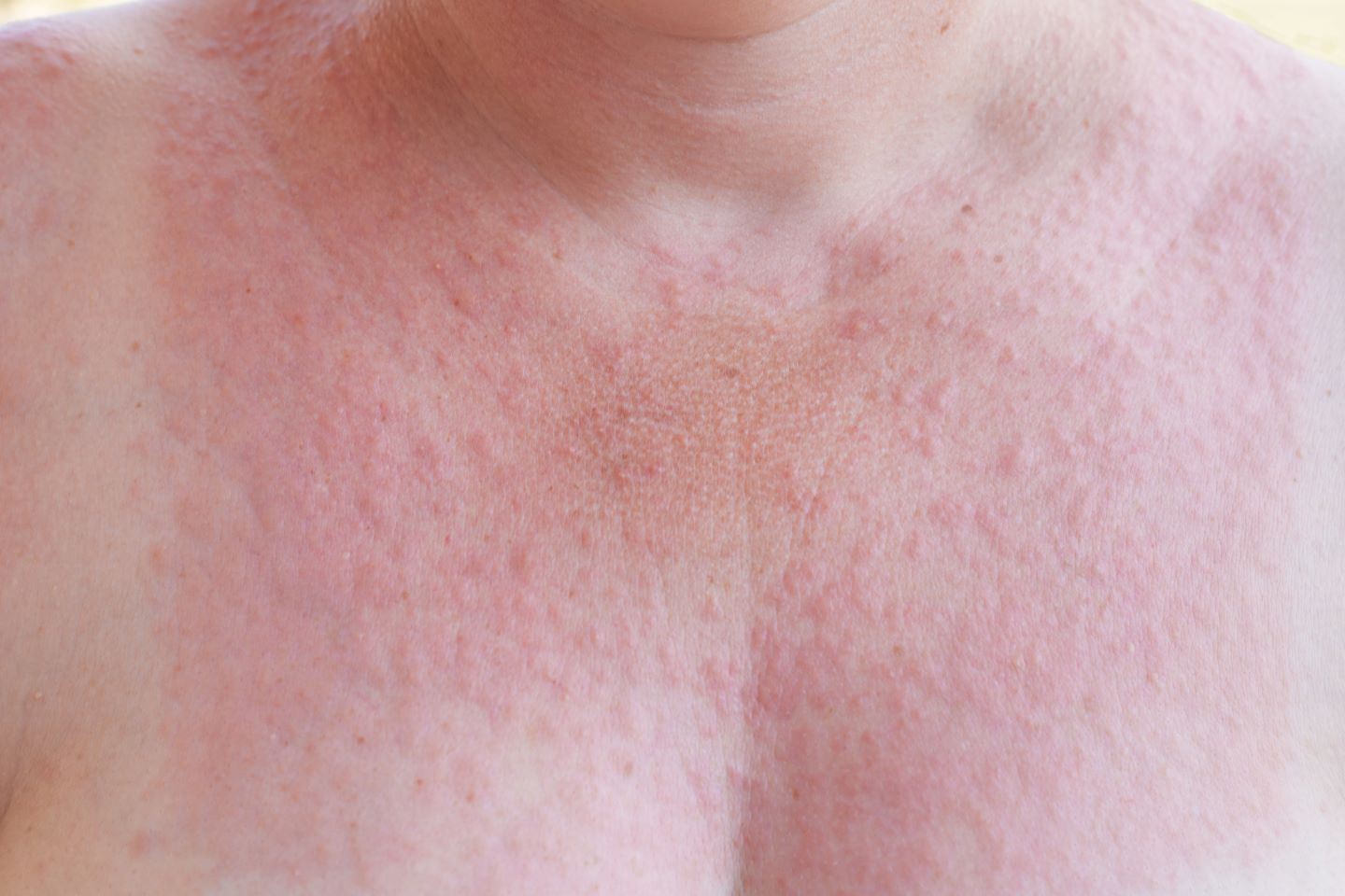 Foto urticaria solar web