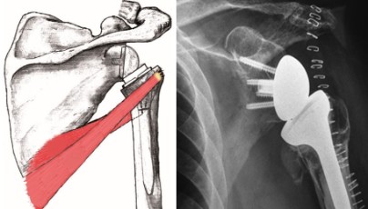 Prótesis invertida de hombro con transferencia de dorsal derecho