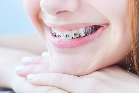 Brackets metálicos