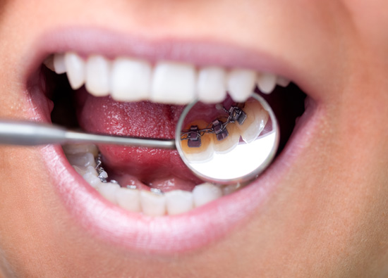 Brackets linguales
