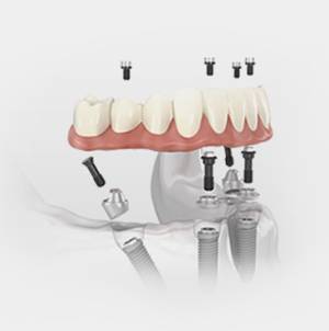 Dientes fijos desde el primer día
