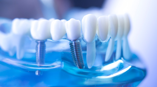 Implantes Cigomáticos
