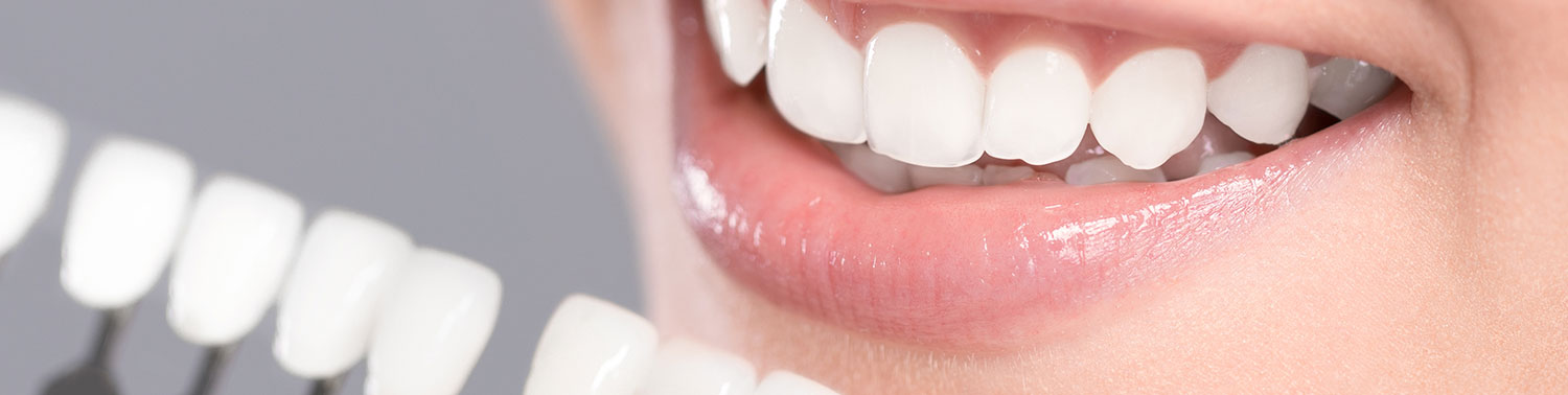 BlanqueamientoDental-cabecera