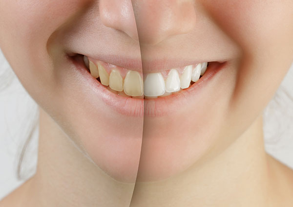Por qué es necesario un blanqueamiento dental