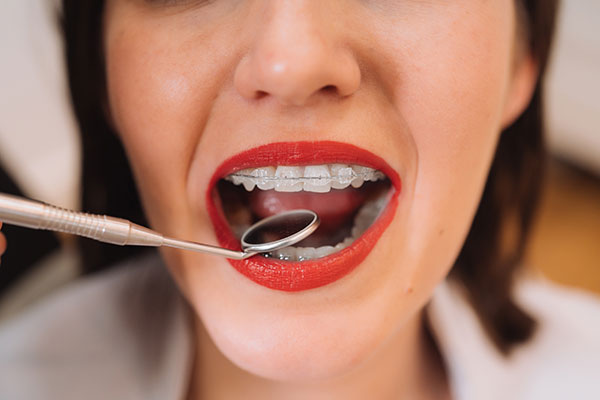 Tipos de brackets