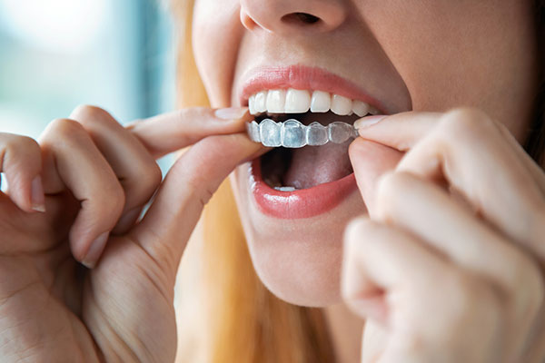 Ventajas-Invisalign