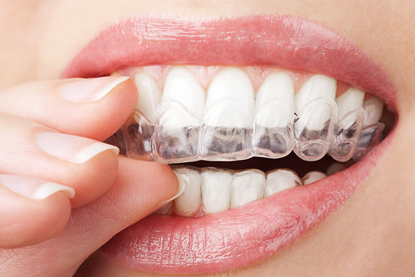 Ortodoncia-Invisalign