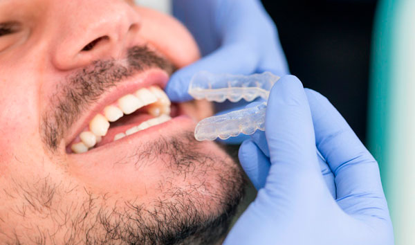 Invisalign