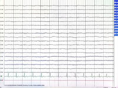 electroencefalograma 2