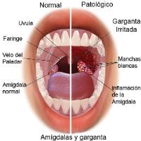 garganta -amigdalaweb