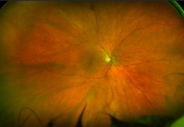 lowretinopatia