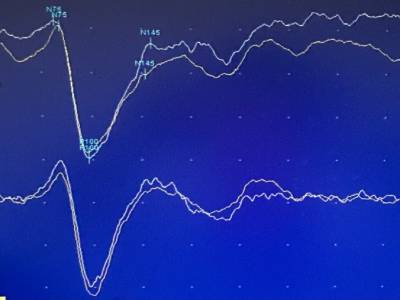 potenciales evocados visuales pev 2