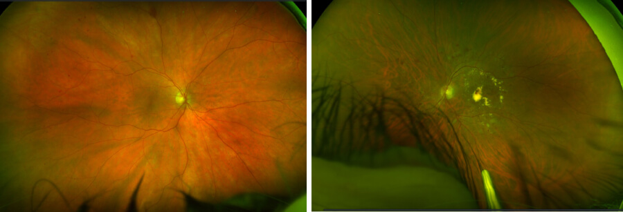 retinopatia diabetica