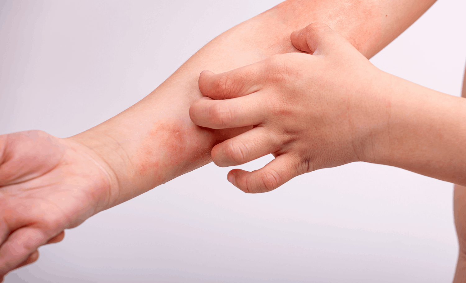 Dermatitis atópica