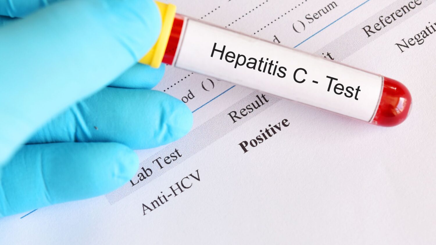 Hepatitis-C-1500x844