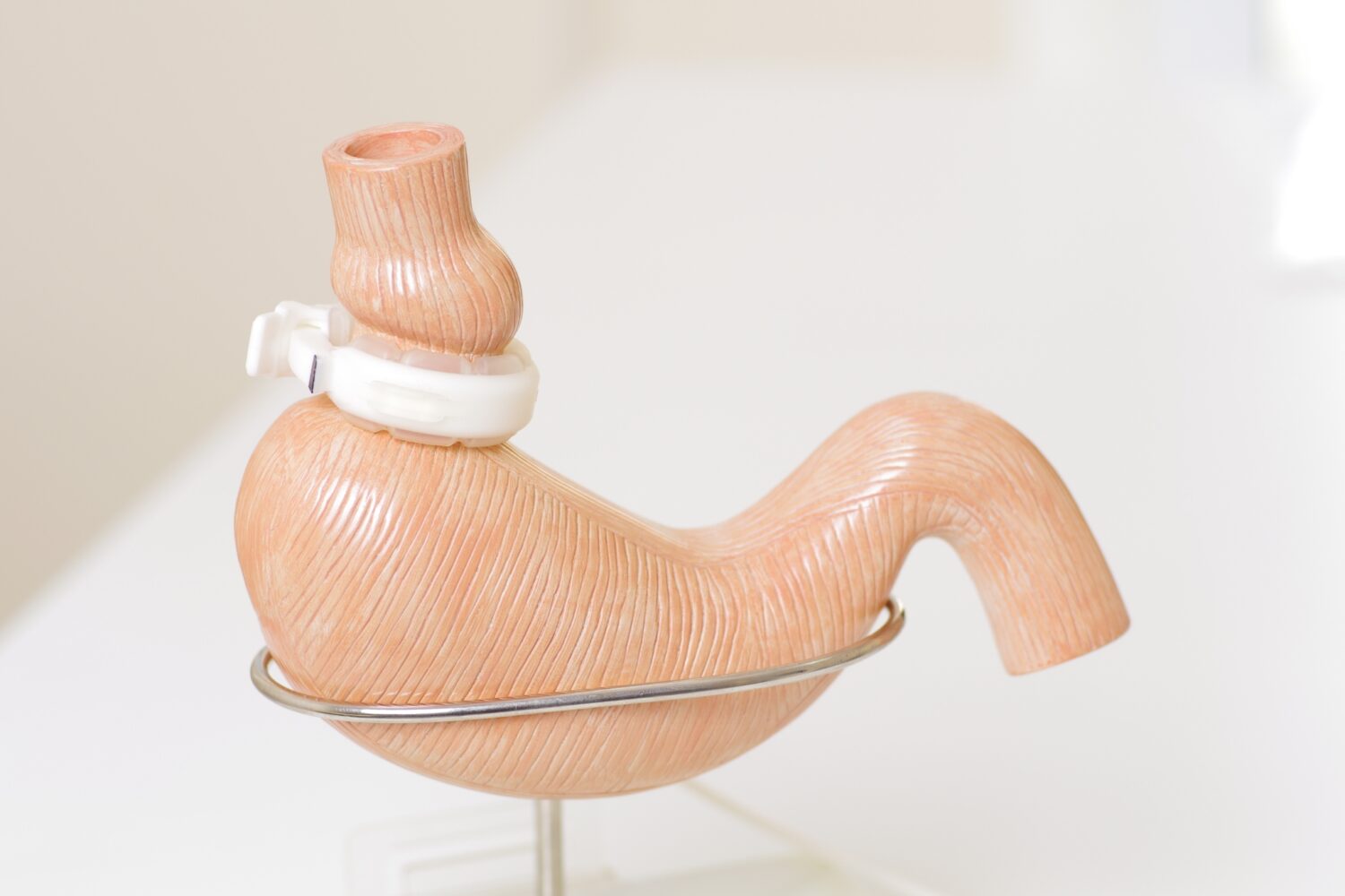 Cirugia-Bariatrica-1500x1000