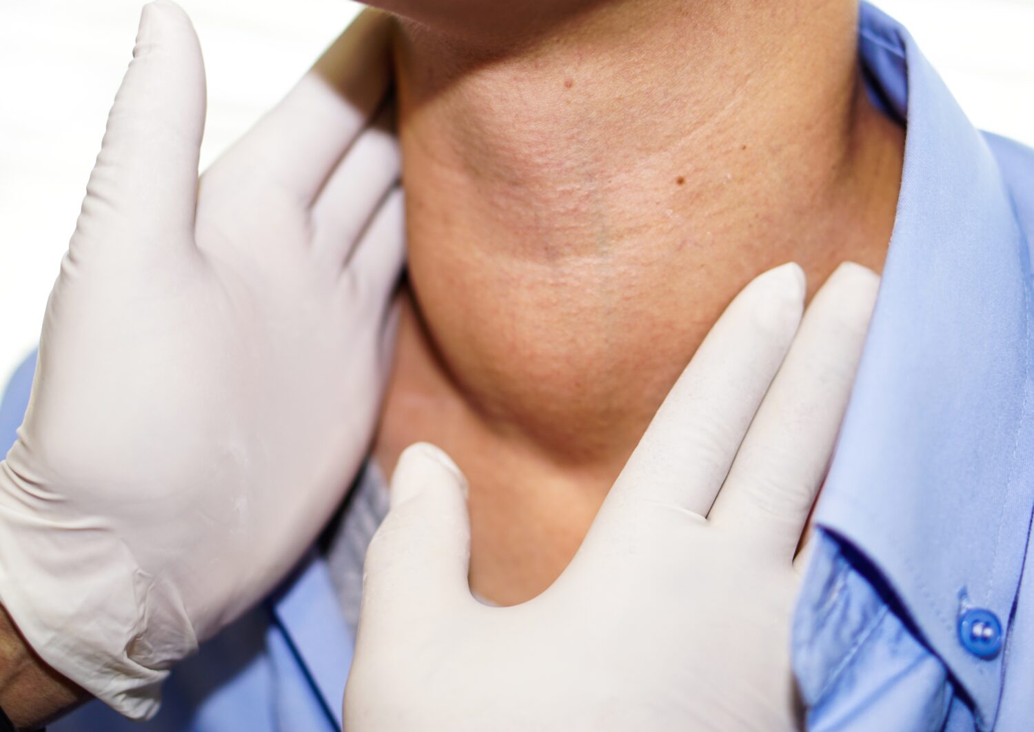 HIPERTIROIDISMO-1500x1061