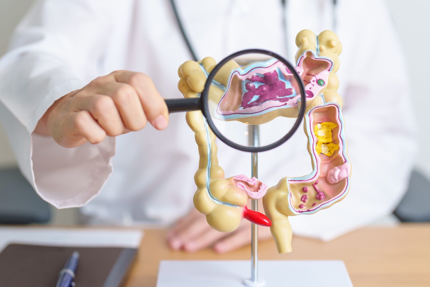 Diverticulitis-1500x1000