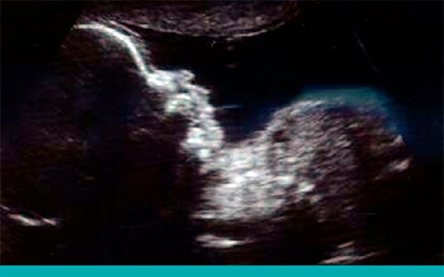 Semana20_Ecografía de las 20 semanas