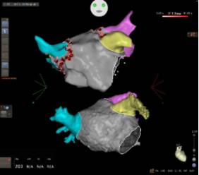 Sistema de navegación cardiaca CARTO