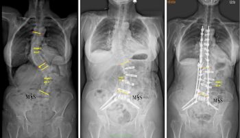 escoliosis degenerativa dorsolumbar severa mujer 80 anos
