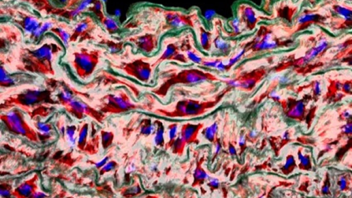 Imagen de microscopía de un aneurisma torácico en animales con síndrome de Marfan