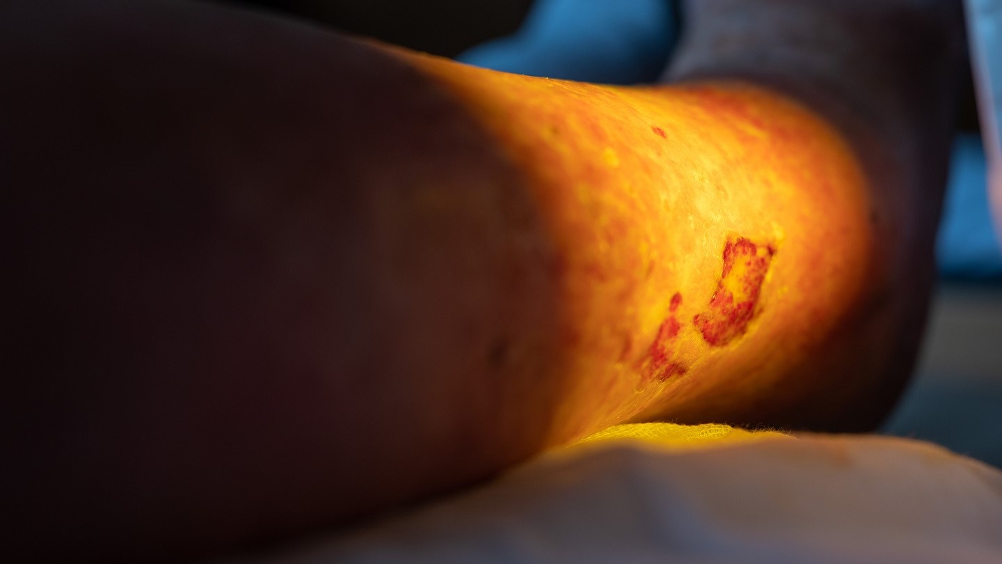 Las heridas mal tratadas pueden permanecer abiertas durante años, impactando gravemente en la calidad de vida del paciente