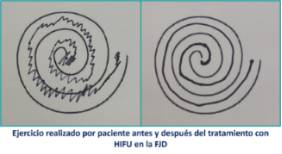 2024 05 28 Ejercicio realizado por paciente antes y después del tratamiento con HIFU en la FJD