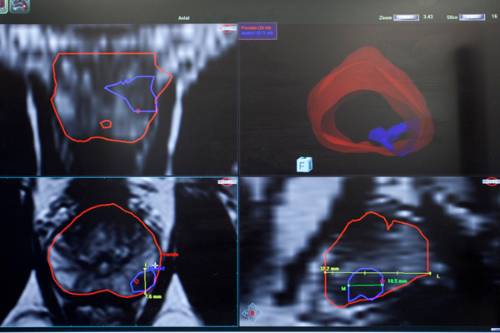 BIOPSIA DE PROSTATA POR FUSION 2 campodegibraltar