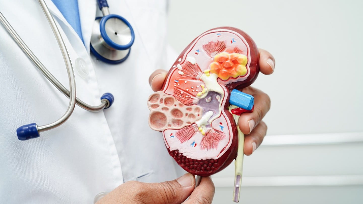 La enfermedad renal crónica es una pérdida de la función renal o presencia de daño renal que puede derivar en fallo renal que requiera diálisis o trasplante