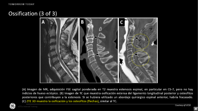 ossification