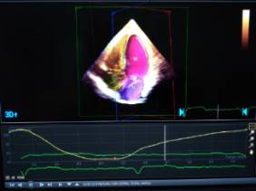 Heart Model dinámico