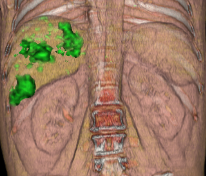 Radioembolización de metástasis hepática con moléculas de 90 Yitrio